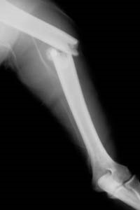 bone-fracture
